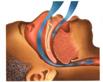understand the causes to know how to stop snoring
